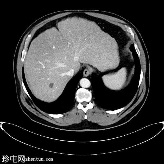 肝癌合并腹腔积血因肿瘤直接侵犯右膈