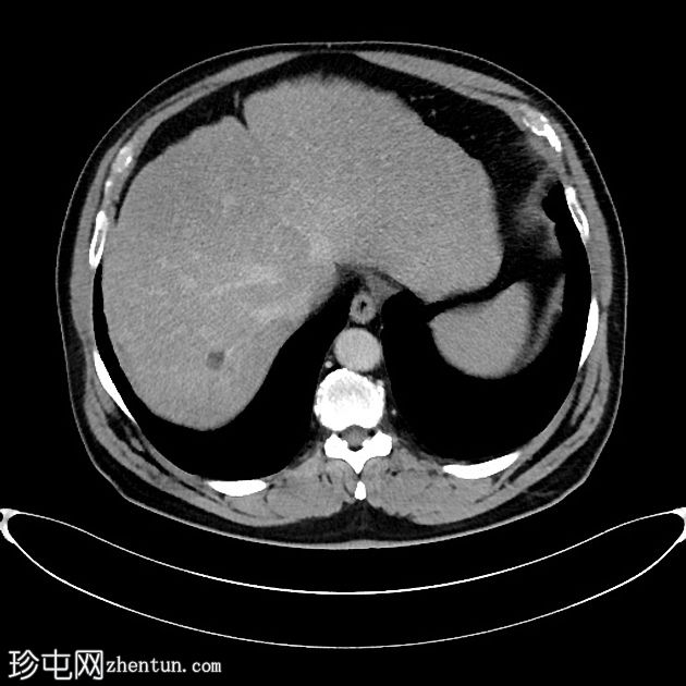 肝癌合并腹腔积血因肿瘤直接侵犯右膈