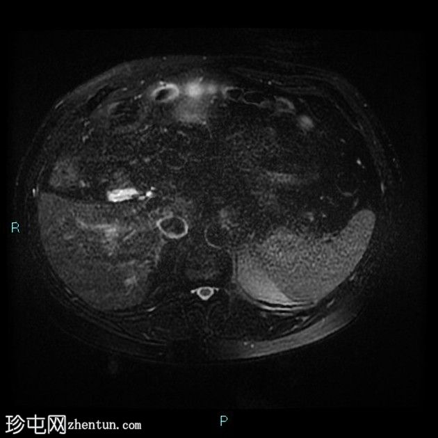 胆囊切除术后残留胆囊管综合征