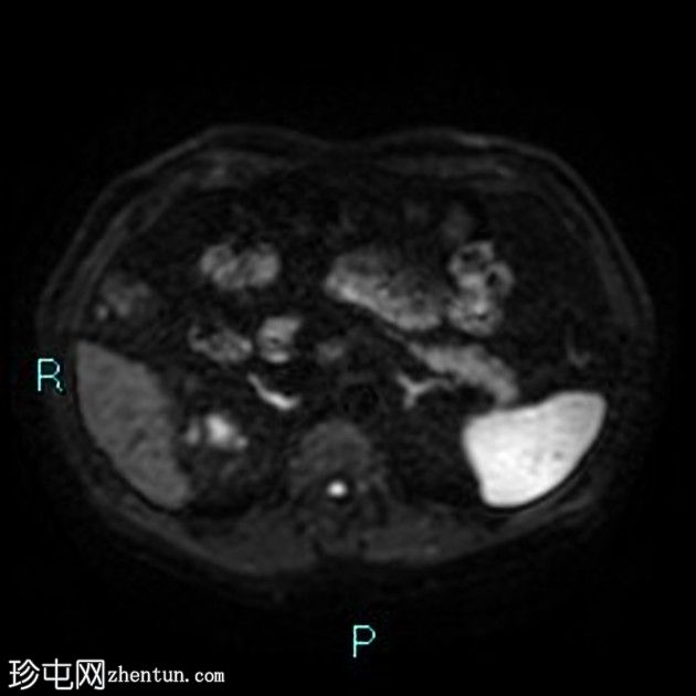 胆囊切除术后残留胆囊管综合征