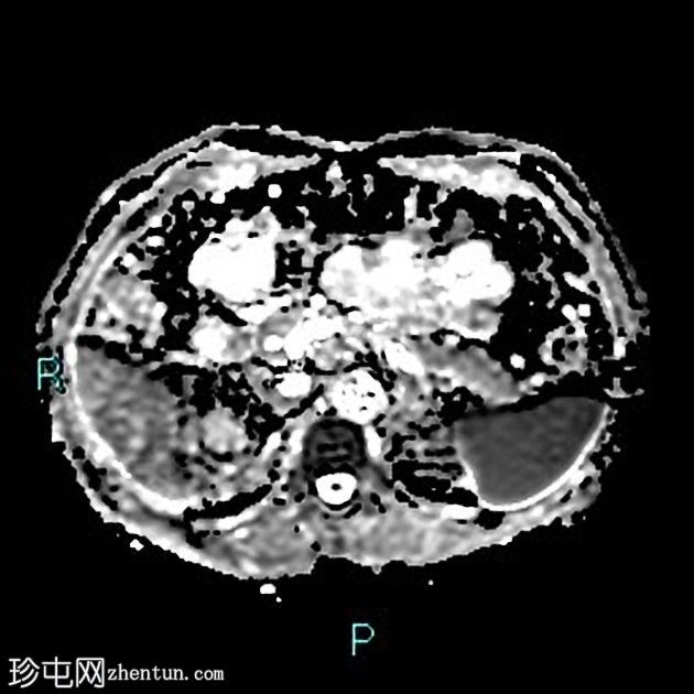 胆囊切除术后残留胆囊管综合征