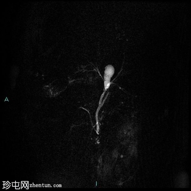 胆囊切除术后残留胆囊管综合征