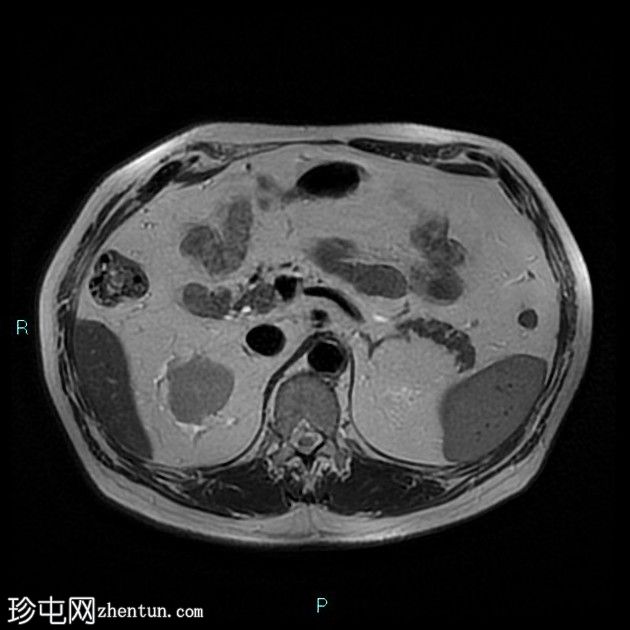 胆囊切除术后残留胆囊管综合征