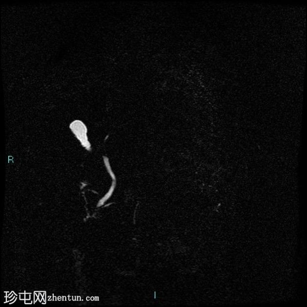 胆囊切除术后残留胆囊管综合征