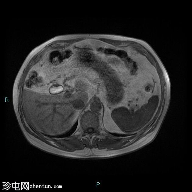 胆囊切除术后残留胆囊管综合征