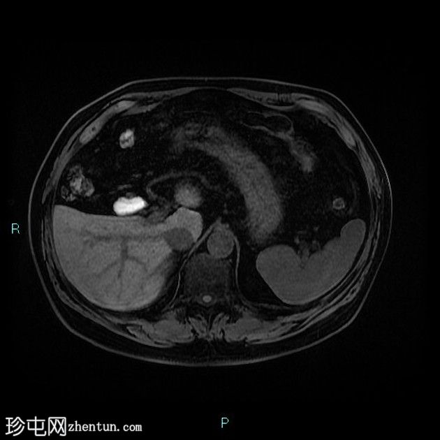 胆囊切除术后残留胆囊管综合征