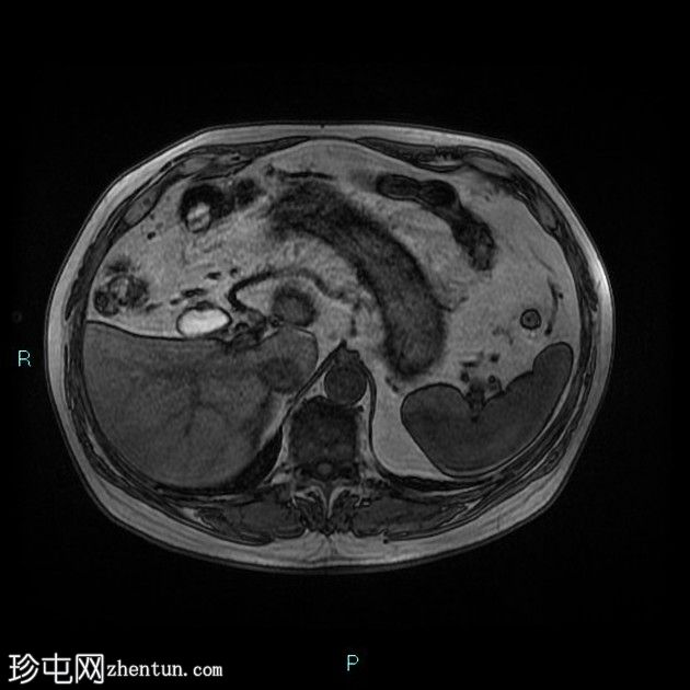 胆囊切除术后残留胆囊管综合征