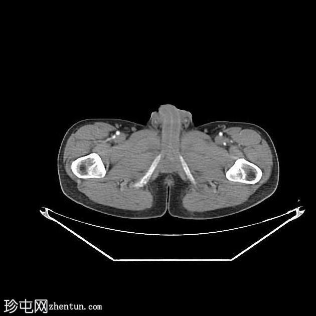 原发性肝鳞状细胞癌