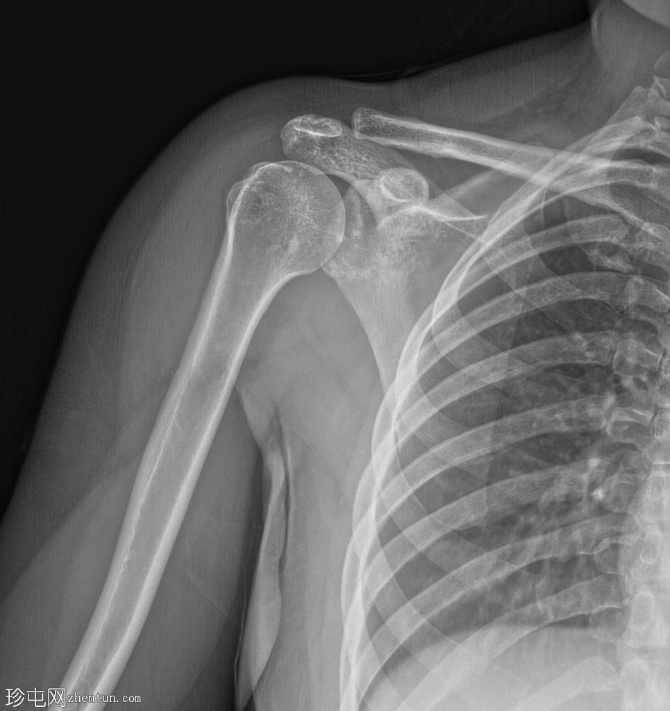 骨斑点症(Osteopoikilosis)
