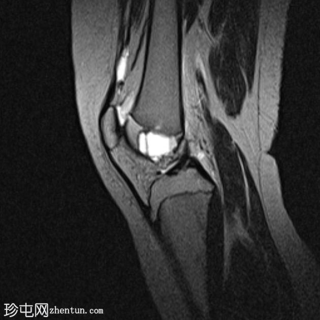 骨骺动脉瘤样骨囊肿