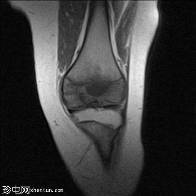 骨骺动脉瘤样骨囊肿