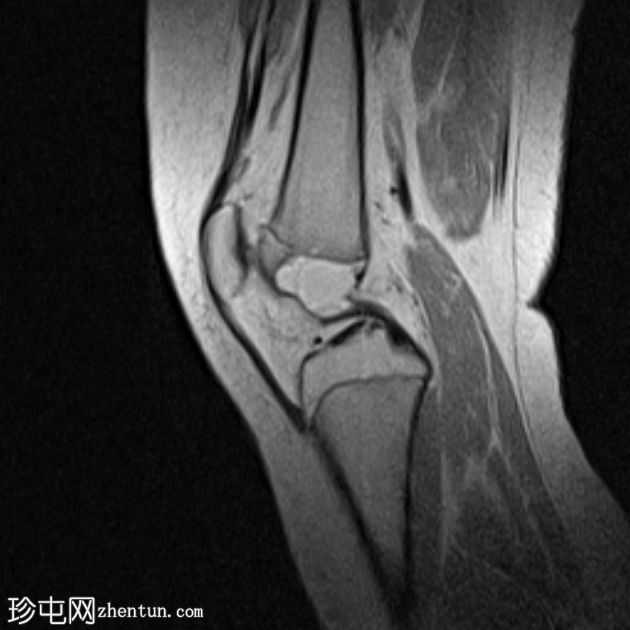 骨骺动脉瘤样骨囊肿