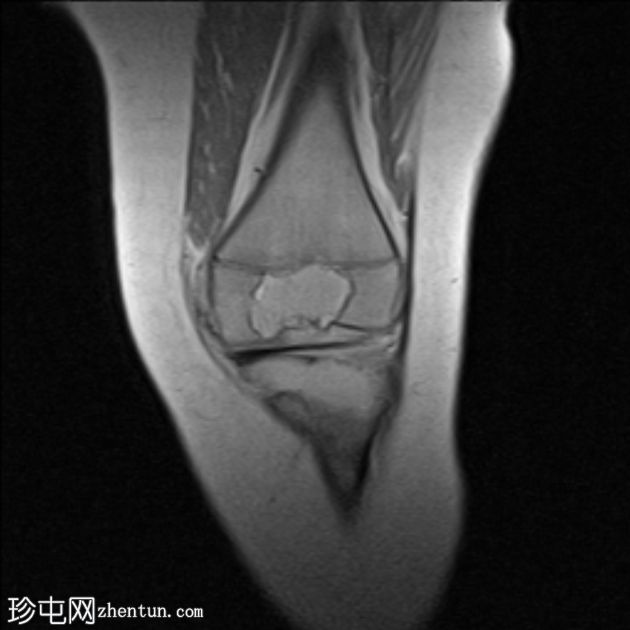 骨骺动脉瘤样骨囊肿