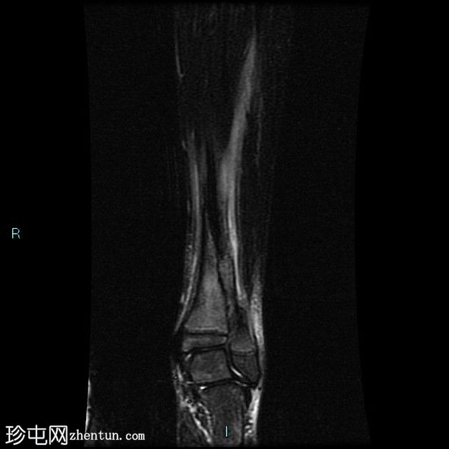 病理性骨折-非骨化纤维瘤