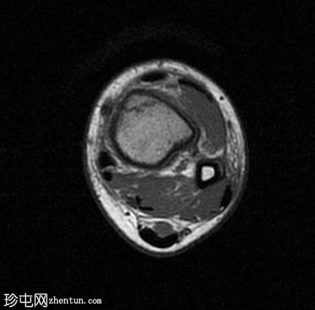 病理性骨折-非骨化纤维瘤