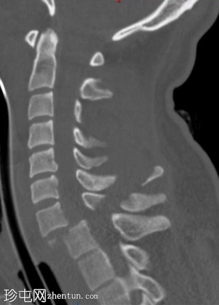 颈椎骨折伴脱位和锁定