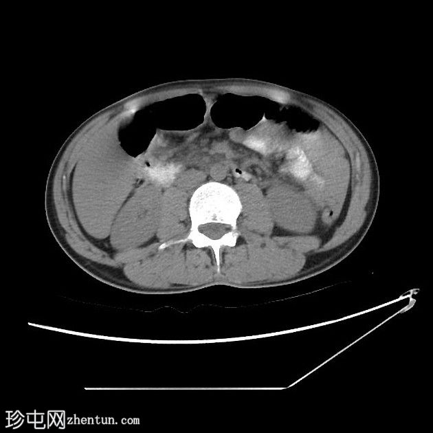 急性胰腺炎与慢性胰腺炎