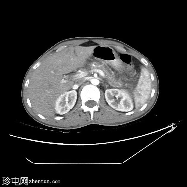 急性胰腺炎与慢性胰腺炎