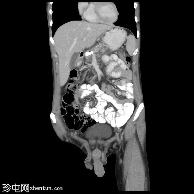 急性胰腺炎与慢性胰腺炎