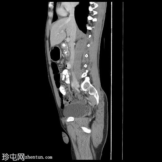 急性胰腺炎与慢性胰腺炎