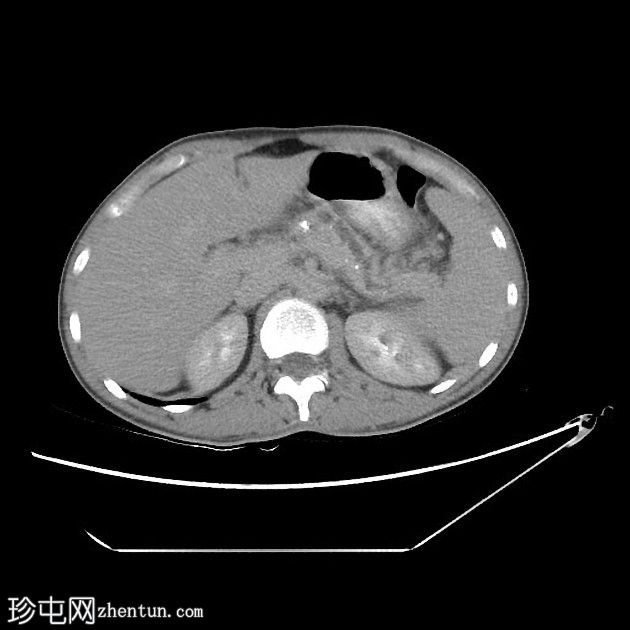 急性胰腺炎与慢性胰腺炎