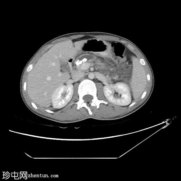 急性胰腺炎与慢性胰腺炎