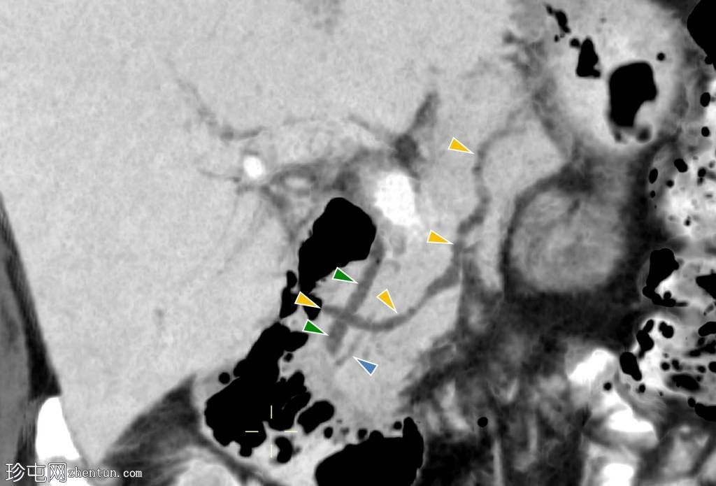 胰腺分裂症(pancreas divisum, PD)