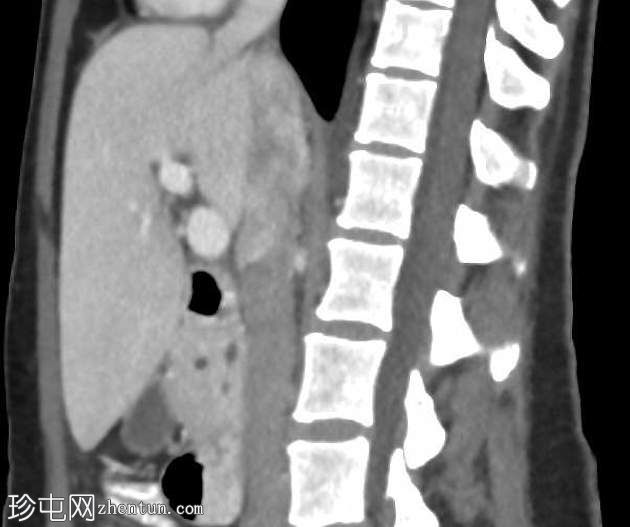 胰腺分裂症(pancreas divisum, PD)