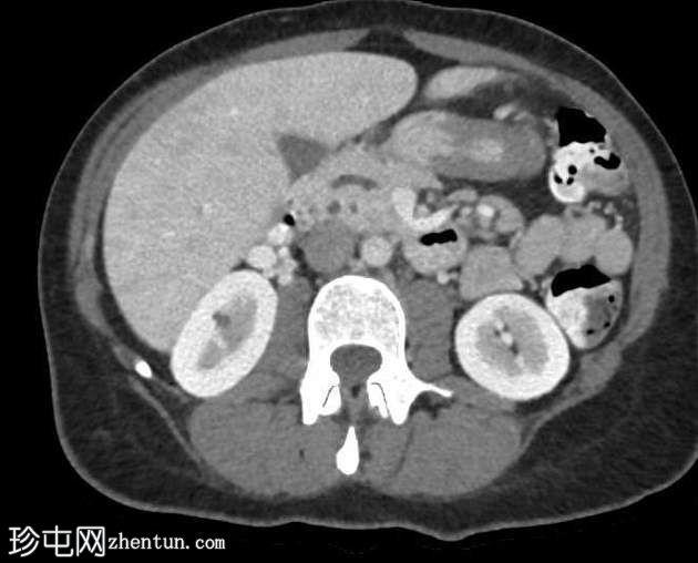 胰腺分裂症(pancreas divisum, PD)