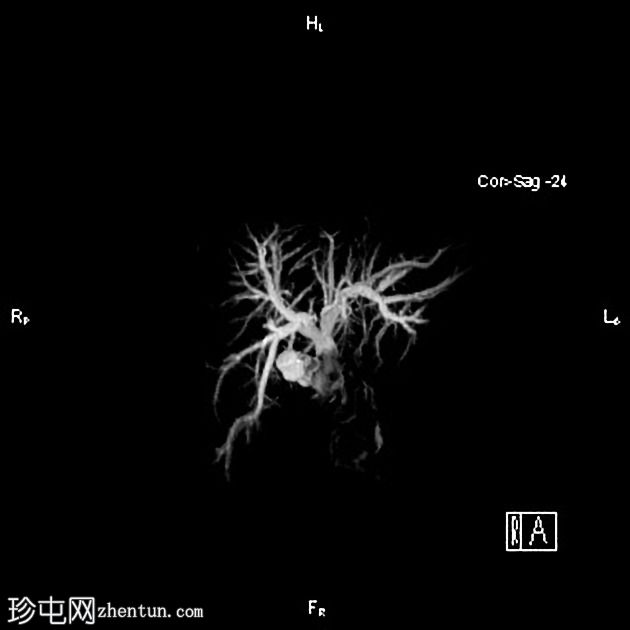 胆石病和黄疸