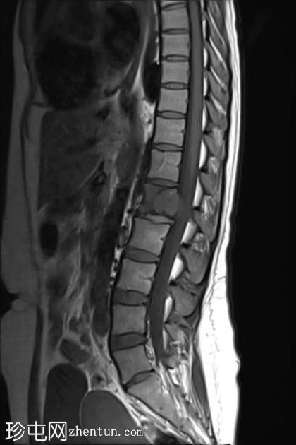 巨细胞瘤-脊柱