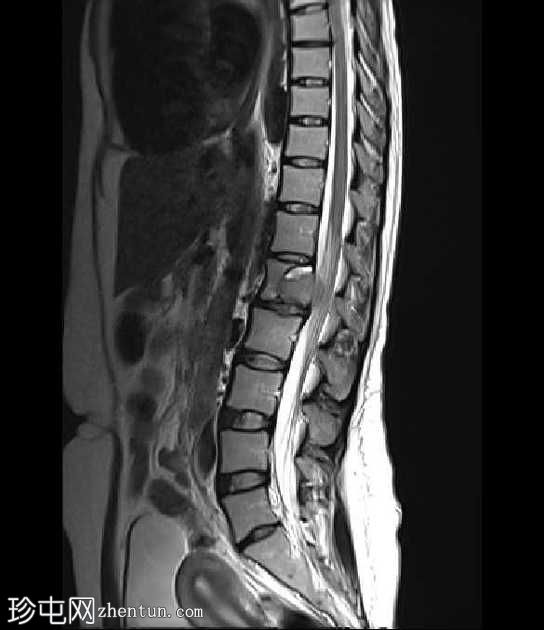 巨细胞瘤-脊柱