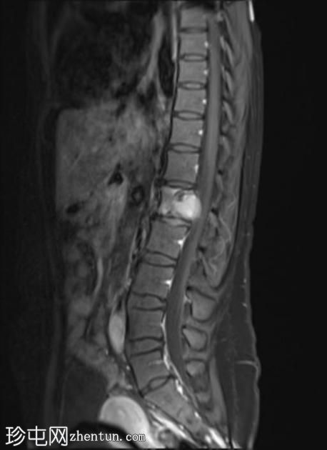 巨细胞瘤-脊柱