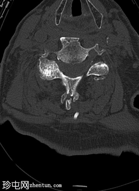 复杂颈椎骨折