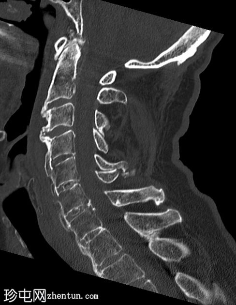 复杂颈椎骨折