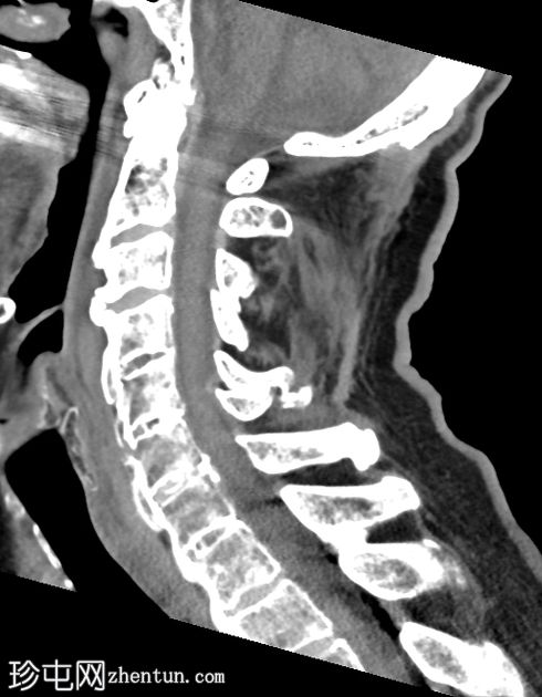 复杂颈椎骨折