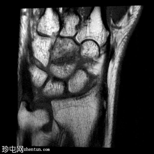 孤立的头状骨折