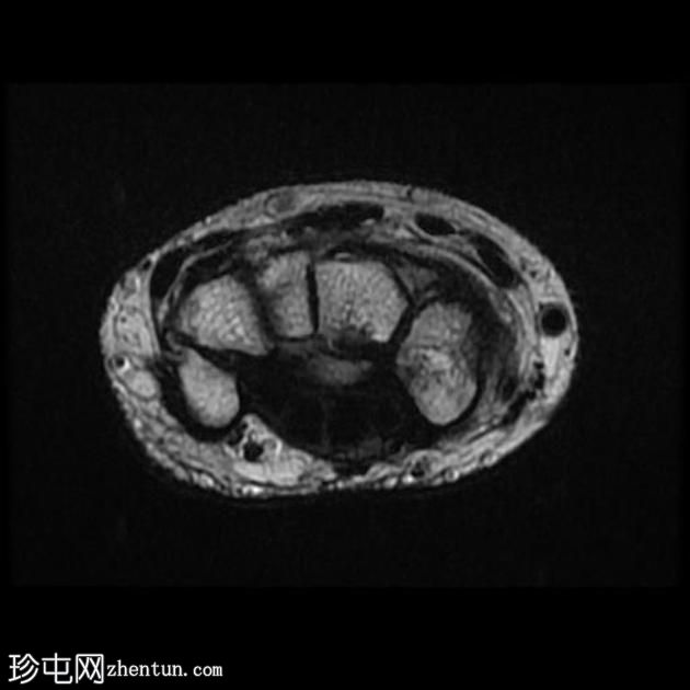 舟状骨假关节