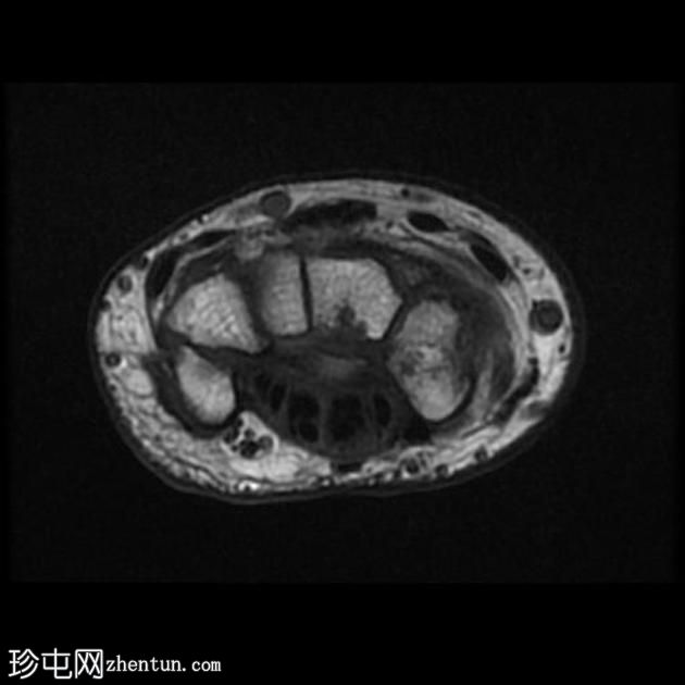 舟状骨假关节