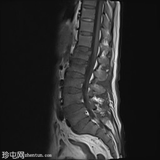 急性髓系白血病-弥漫性骨髓浸润