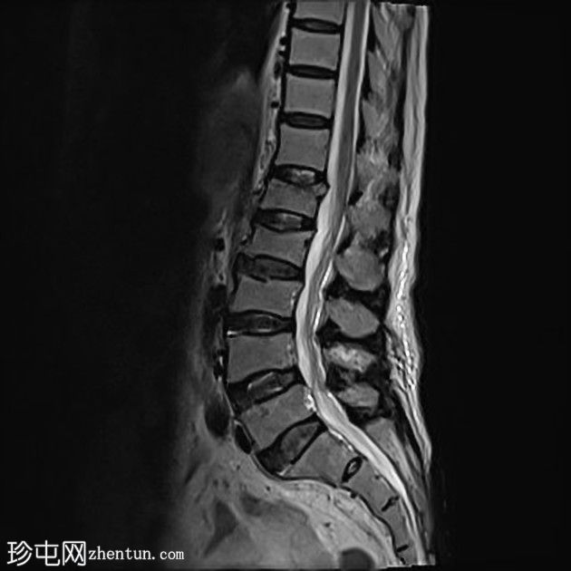 急性髓系白血病-弥漫性骨髓浸润