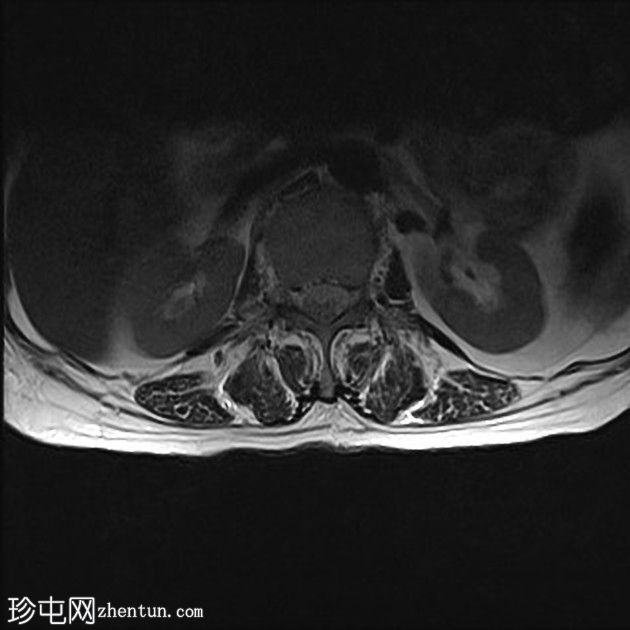 急性髓系白血病-弥漫性骨髓浸润