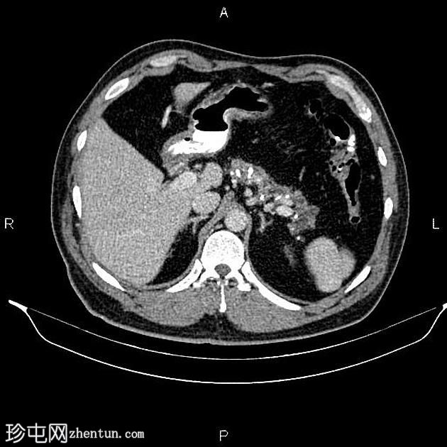 慢性胰腺炎