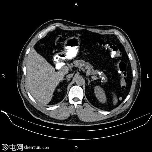 慢性胰腺炎