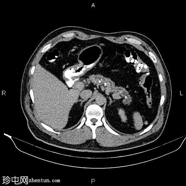 慢性胰腺炎