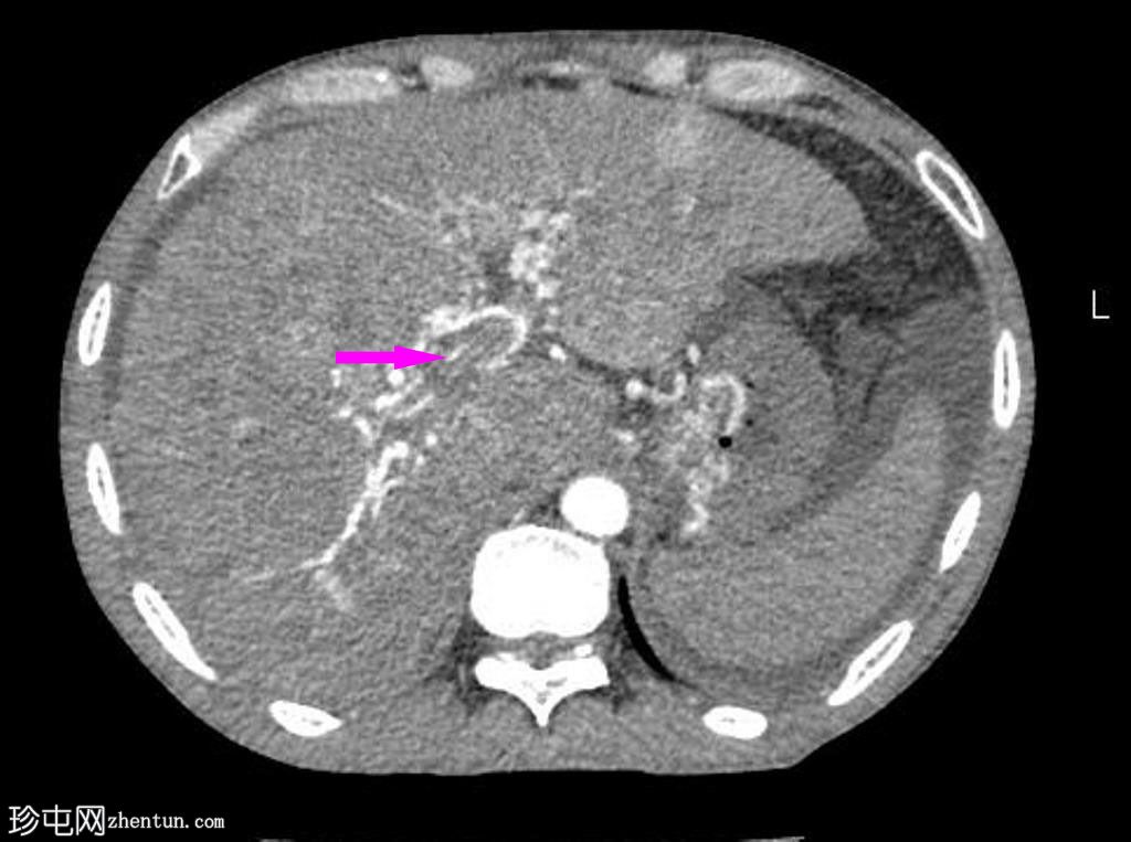 弥漫性肝细胞癌合并恶性门静脉血栓形成和门静脉动脉分流