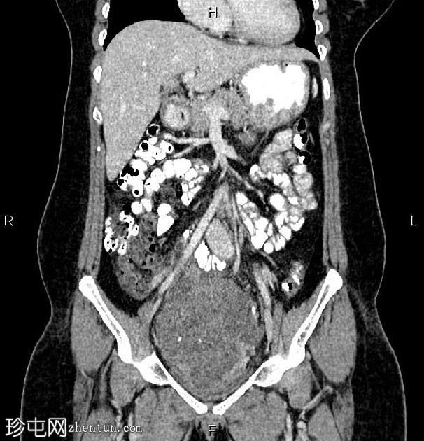 子宫平滑肌肉瘤