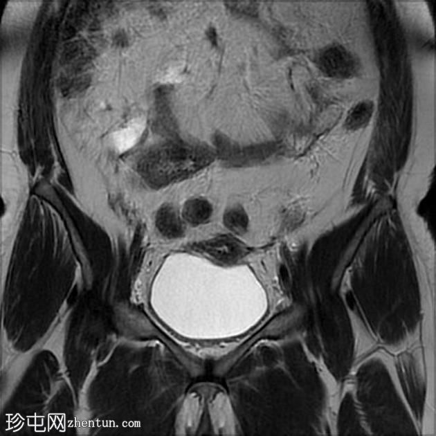 疤痕子宫内膜异位