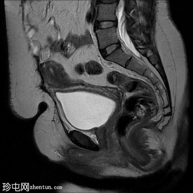 疤痕子宫内膜异位