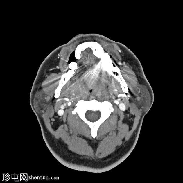 环甲状腺切除术治疗重度会厌炎